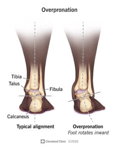What Is Overpronation